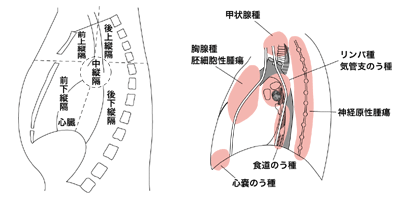 図：縦隔腫瘍のできやすい部位