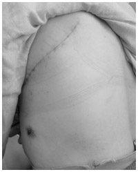 写真：開胸手術による左上側面の傷あと