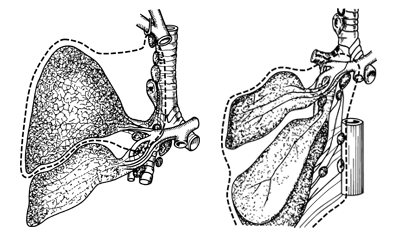 図：肺の葉切除（左）