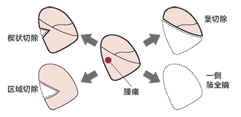 図：肺の切除方法