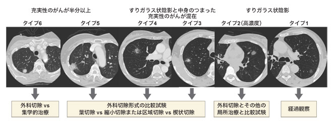 図：小型腺がんの分類と治療法