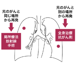 図：再発肺がん