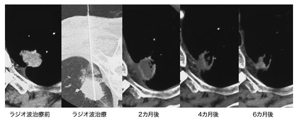 転移性肺がん患者さん(転移は肺のみ)が治癒した例