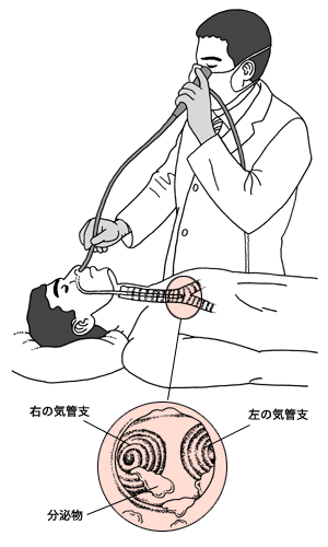 図：気管支鏡検査