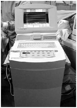 写真：米エンドケア社の凍結治療機器