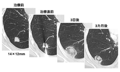 図：直腸がんが肺転移した50歳代の女性のケース