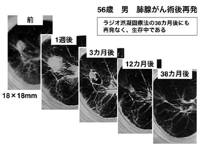 図：肺腺がんの50歳代の男性のケース