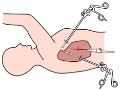 図：胸腔鏡手術