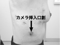 写真:胸腔鏡下手術創(肺葉切除)