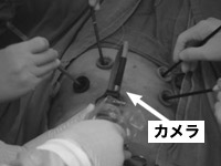 写真:胸腔鏡下手術(肺葉切除)