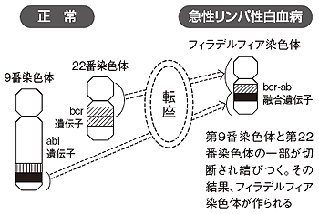 フィラデルフィア染色体を持つ急性リンパ性白血病