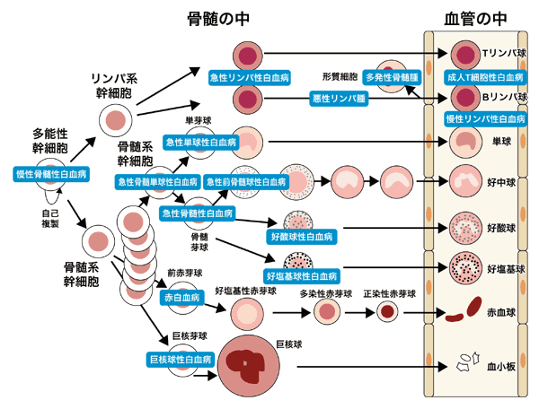 図：血球の分化と白血病になりやすい箇所