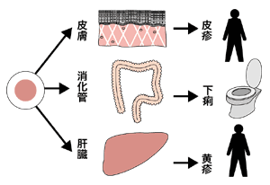 図：移植片対宿主反応病