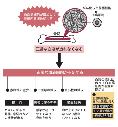 図：白血病のしくみと症状