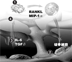 図：多発性骨髄腫によって骨病変があらわれる機序