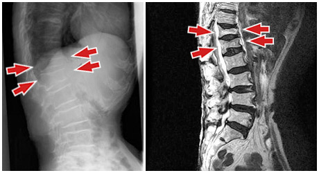 脊椎（腰）の圧迫骨折のX線（左）とMRI画像（右）