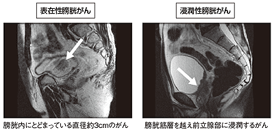 写真2 表在性と浸潤性の転移のしやすさ（MRI画像）