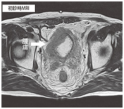 初診時MRI
