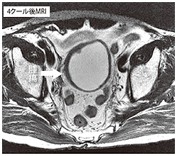 4クール後MRI