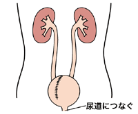 図:自排尿型代用膀胱
