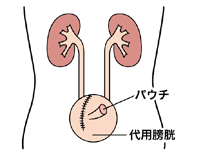 図:自己導尿型代用膀胱