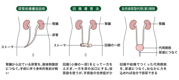 図:尿路変向の方法