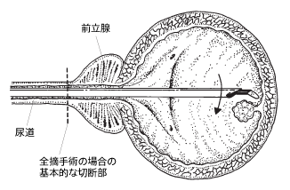 膀胱鏡を用いて行う経尿道的膀胱腫瘍切除術の方法