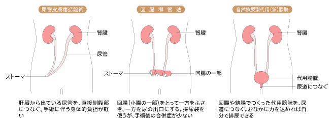 尿路変向術各種