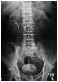 排泄性（静脈性）腎盂造影検査の写真