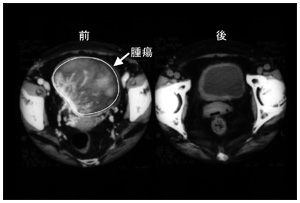 写真:浸潤性膀胱がんに対する動注放射線治療の治療前後のCT