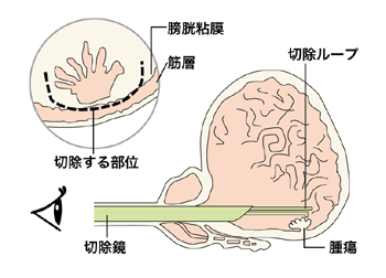 図：経尿道的膀胱腫瘍切除術
