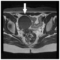 卵巣子宮内膜症（MRI）