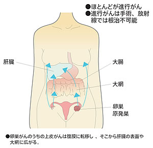 卵巣がんの転移、広がり方