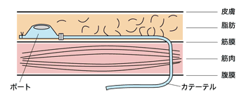 図：抗がん剤を腹腔内に注入するためのポート