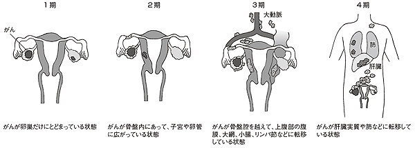卵巣がんの進行度は?