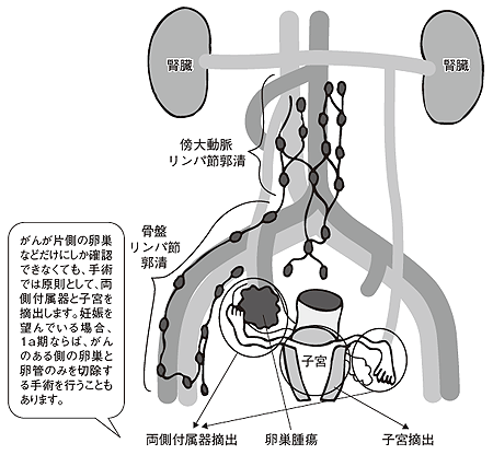 手術ではどこを切除するの?