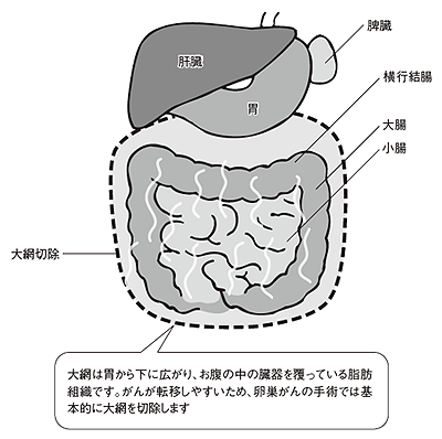 手術ではどこを切除するの?