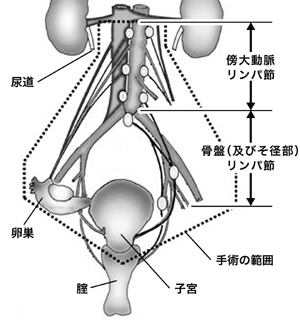図:卵巣がんの手術