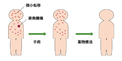 図：乳がん治療のイメージ
