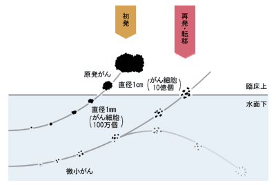 図：乳がんの微小転移