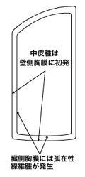 図:壁側と臓側にできる胸膜腫瘍の違い