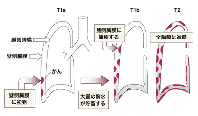 図:胸膜中皮腫の発病と進展の様子
