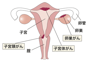 図：女性のがん、3種類の位置