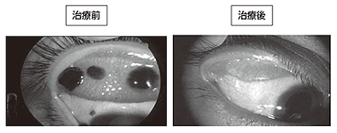 炭酸ガスレーザーを使用した結膜メラノーマの眼球保存療法