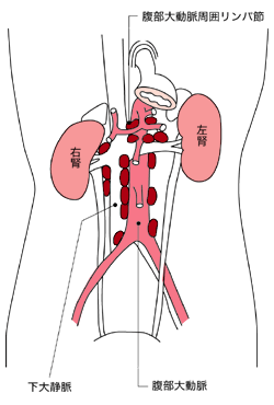 図:リンパ節拡大郭清