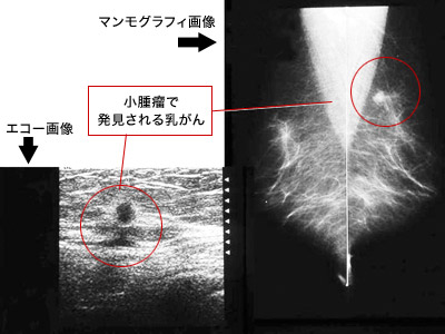 視触診ではわからなかった乳がんの症例（50歳以上）