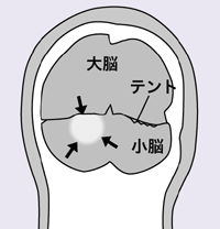 MRI画像解説イラスト
