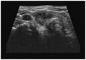 甲状腺がん超音波検査画像
