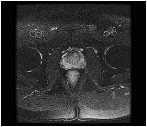 前立腺がんMRI脂肪抑制画像