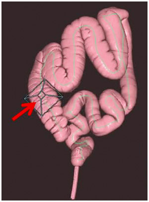 「仮想内視鏡」検査で読影中の大腸内における位置